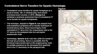 Video 288 1 Peripheral Nerve Surgery for Central Nervous System Disorders