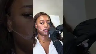 Facial Balancing at Galore Medical  #skincare #facialbalancing #filler  #beauty