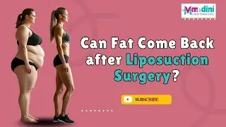 Can Fat Come Back After Liposuction? | Does Fat Regrow After Lipo Surgery | Medini Cosmetic Surgery