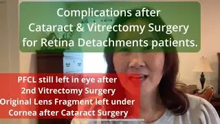 More complications after cataract and 2nd vitrectomy surgery.