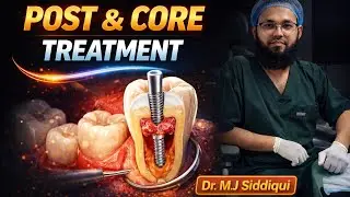 🦷 Post & Core + Zirconia Crown Treatment #shorts 