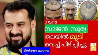 #ACTOR SAJAN SURYA HAIR TRANSPLANTATION#Hair Transplant Safari Malayalam#
