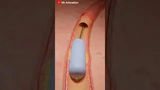 Coronary Angioplasty Procedure - 3D Animation #shorts