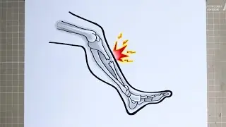 How to Draw BROKEN LEG 