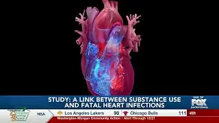 Research suggests link between intravenous drug use and fatal heart valve infections