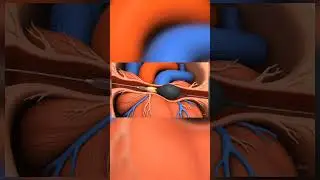 angioplasty procedure |animation | biology #medical #animation #medicalfield #health