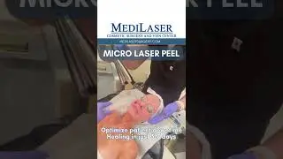 Micro laser peel