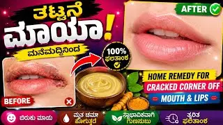 ತುಟಿಯ ಮೂಲೆಯಲ್ಲಿ ಬಿರುಕು/ನೋವಿಗೆ ಮನೆಮದ್ದು| Home Remedies for Cracked Corner of Mouth|Angular Cheilitis