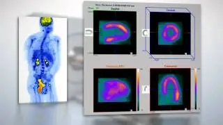 ECAT SCINTRON - PET Scanner by MiE