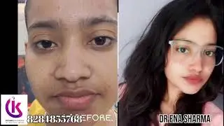 Acne care solutions for teenage