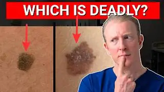 Mole vs Melanoma: 3 Things You MUST Know