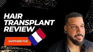 Hair Transplant in Confidenthair | Hair Transplant Patient Review