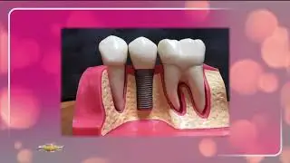 What are Teeth Implants? - The Art of Dentistry - Dr. Robin Rutherford on Studio 7