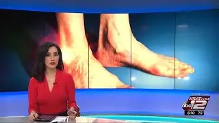 VIDEO: Is total replacement the cure for treating ankle arthritis?