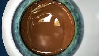 Vision Correction for High Levels of Myopia & Astigmatism