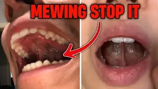 This 3 Mewing Mistakes Are Not Allowing You To Be Attractive, Stop Them Today Itself.