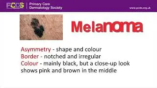 PCDS Melanoma FINAL