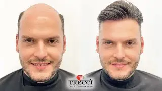 COME INFOLTIRE I CAPELLI SUBITO, Impianto di capelli non chirurgico