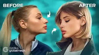 Septoplasty in Istanbul: Patient Experience and Recovery