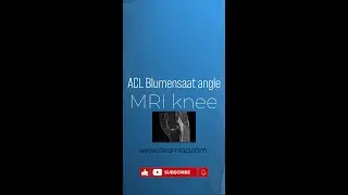 ACL Blumensaat angle- MRI knee