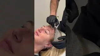 PRP with Hyaluronic Acid Microneedling at Dr Sknn