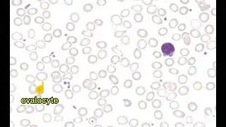 microcytic hypochromic anemia // tear drop cell , elliptocyte, ovalocyte , platelets, lymphocyte.