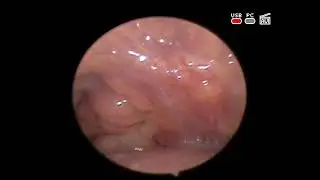 Needle #aspiration remains in this case #treatment of peritonsillar #abscess  ENT Kyiv Ukraine
