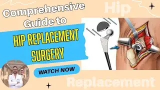 Comprehensive Guide to Hip Replacement Surgery @DrdebashishChanda #hipreplacement