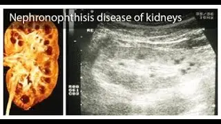 Nephronophthisis (Kidney Genetic Disorder) ; Definition, causes, Symptoms, Diagnosis, Treatment