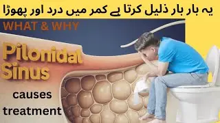 𝐁𝐀𝐂𝐊 𝐏𝐀𝐈𝐍 and 𝐏𝐈𝐋𝐎𝐍𝐈𝐃𝐀𝐋 sinus everything you must know causes,test,treatment साइनस और साइनस