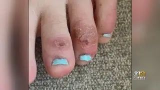Doctors Researching 'COVID Toes'