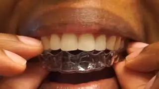 It's here!!!! | 2 Weeks Without A Retainer | Before & After | Life After Braces