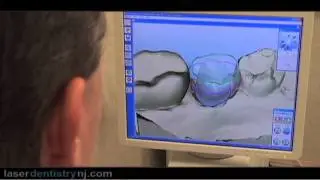 CEREC Dental Crowns New Jersey