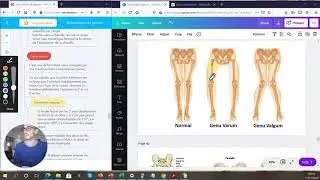 GENU VARUM, GENU VALGUM ET GENU RECURVATUM + AXE MÉCANIQUE DU MEMBRE INFÉRIEUR