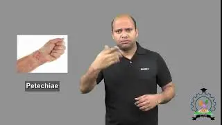Petechiae