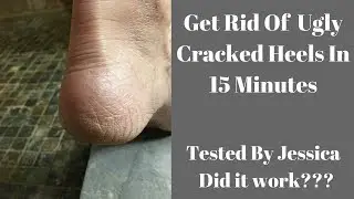 Get Rid of Dry Cracked Heels With a Listerine Foot Soak: Does It work?