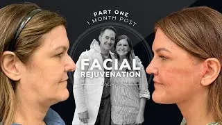 Jaclyn's Story: 1 Month Post Facial Rejuvenation - PART ONE