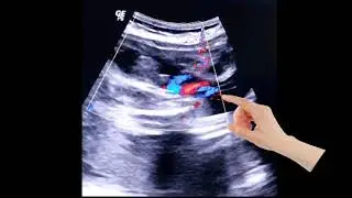 Baby Boy  + 3 vessel cord &  Posterior Placenta  | Baby Girl + 3 vessel cord & Posterior Placenta