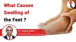 What Causes Swelling of the Feet || Swelling of the feet