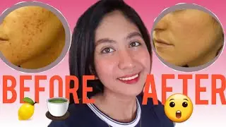 MABISANG pantanggal ng PIMPLES at PIMPLE MARKS ng walang GASTO || Sarah Y.