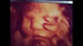 3D scan at 32 weeks - Surrogacy - VEODA