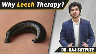 Why Leech Therapy? | Benefits of LEECH THERAPY | LEECH THERAPY IN DETAIL
