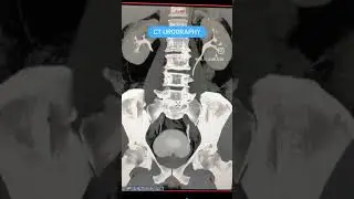 CT Urography MIP #shorts #youtubeshorts #viral