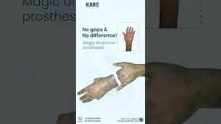 Top Prosthetic Expert Reveals SECRET to Seamless Silicone Prosthesis
