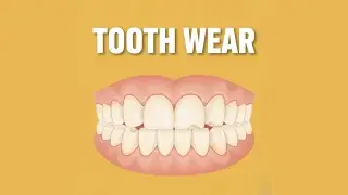 TOOTH WEAR