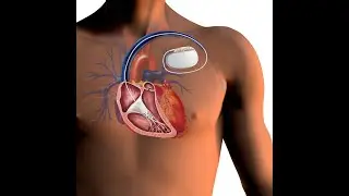 AICD - Automated Implantable Cardioverter - Defibrillator - Pacer - Dr Rams Medical Coding Academy