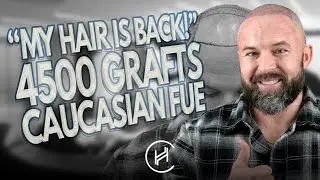 Doświadczenie z przeszczepem włos&oacute;w 4500 Grafts | Pacjent z Teksasu opowiada o swojej wizycie w k...