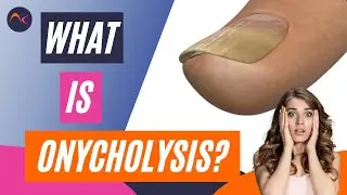 What is Onycholysis? Nail lifting and Separation Explained!