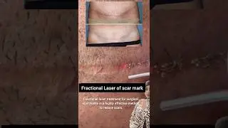 Surgical scar mark treatment