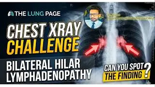 Chest x-ray Challenge - 8 - BiLateral Hilar Lymphadenopathy